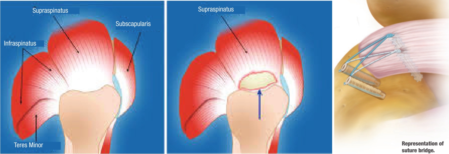 What Does a Rotator Cuff Repair Involve? 